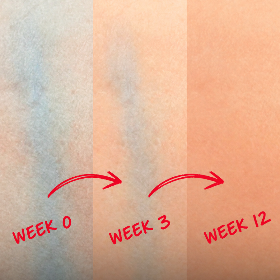 Vein visibility on day one, week 3 and week 12 as skin tone warms