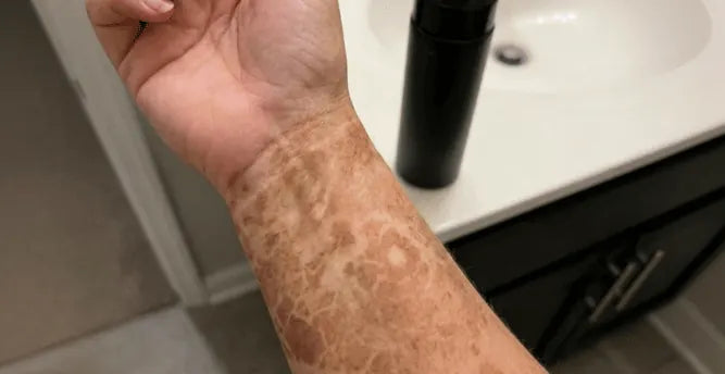 Streaked, patchy false tan on Rainy's forearm